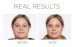PÜR - 4-in-1 Correcting Primer Anti-Blemish Mattifying Acne Treatment - Baza pod makijaż dla skóry trądzikowej - 30 ml 